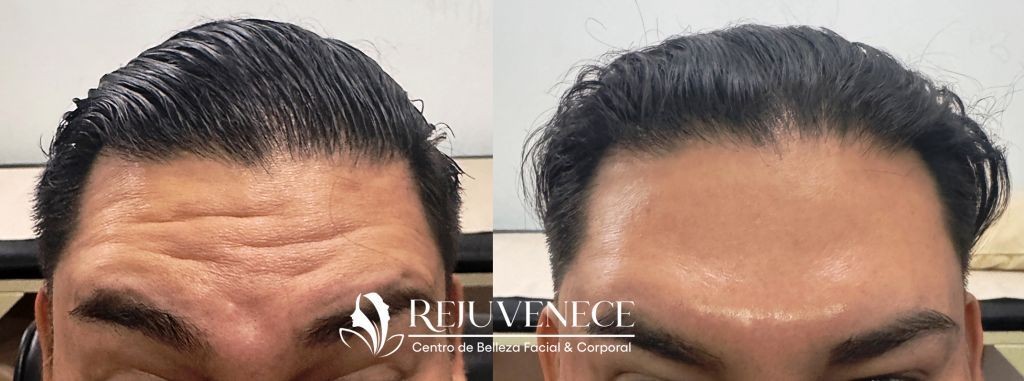 Botox Result 1