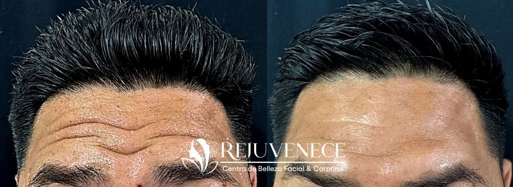 Botox Result 10