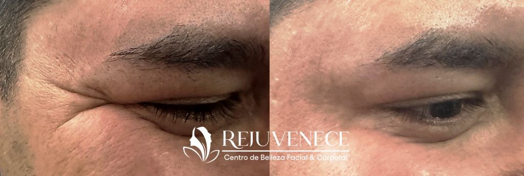 Botox Result 2