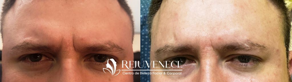 Botox Result 3