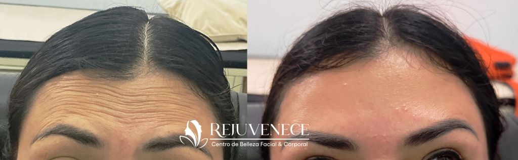 Botox Result 4