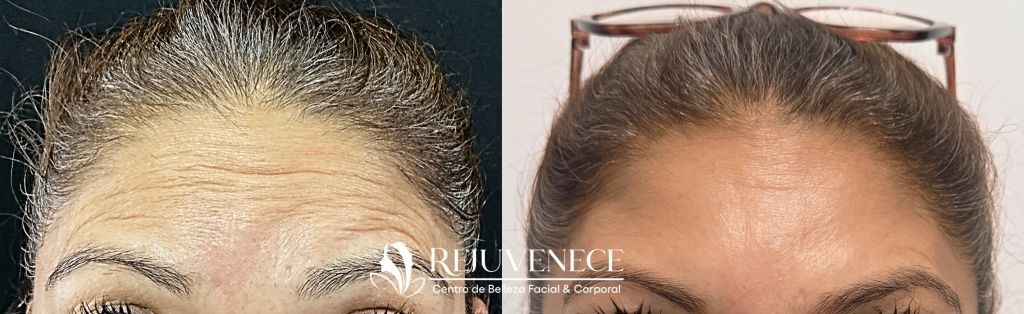 Botox Result 5