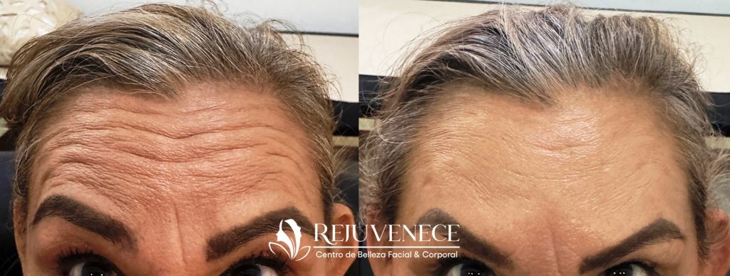 Botox Result 6