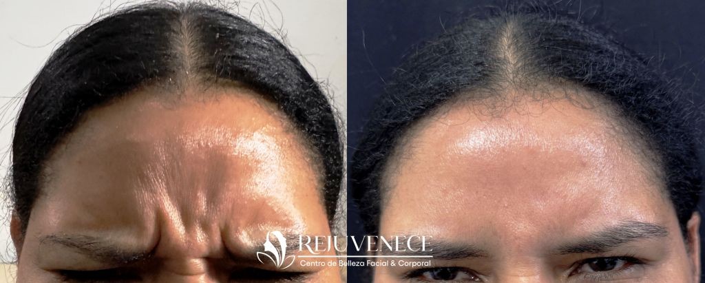 Botox Result 7