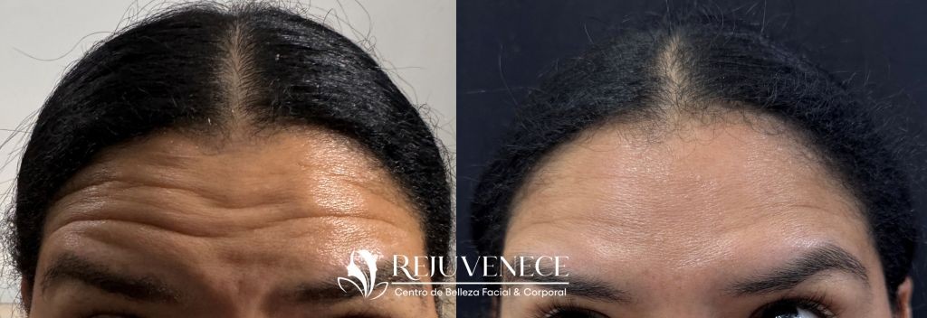 Botox Result 8