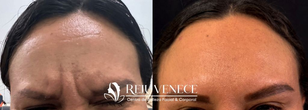 Botox Result 9